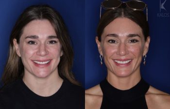 41 year old female almost 2 years out from a modified perialar lip lift