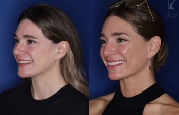 41 year old female almost 2 years out from a modified perialar lip lift