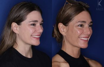 41 year old female almost 2 years out from a modified perialar lip lift