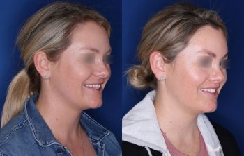 30 year old female 4 months post op from cosmetic rhinoplasty and perialar lip lift