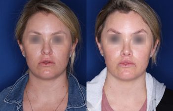 30 year old female 4 months post op from cosmetic rhinoplasty and perialar lip lift