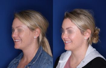 30 year old female 4 months post op from cosmetic rhinoplasty and perialar lip lift