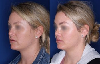 30 year old female 4 months post op from cosmetic rhinoplasty and perialar lip lift