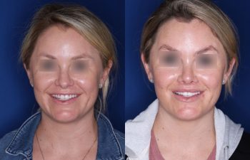 30 year old female 4 months post op from cosmetic rhinoplasty and perialar lip lift