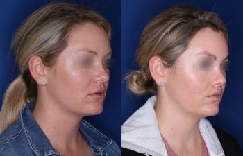 30 year old female 4 months post op from cosmetic rhinoplasty and perialar lip lift
