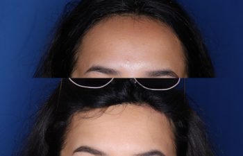 23 year old female 6 months post op from forehead reduction hairline lowering procedure