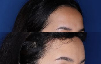 23 year old female 6 months post op from forehead reduction hairline lowering procedure