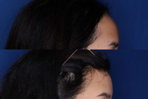 23 year old female 6 months post op from forehead reduction hairline lowering procedure