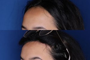 23 year old female 6 months post op from forehead reduction hairline lowering procedure