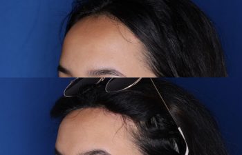 23 year old female 6 months post op from forehead reduction hairline lowering procedure