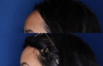 23 year old female 6 months post op from forehead reduction hairline lowering procedure