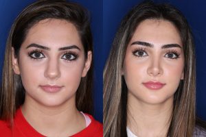 19 year old female 4 months post op from a cosmetic rhinoplasty