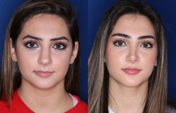 19 year old female 4 months post op from a cosmetic rhinoplasty