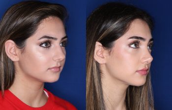 19 year old female 4 months post op from a cosmetic rhinoplasty