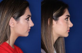 19 year old female 4 months post op from a cosmetic rhinoplasty