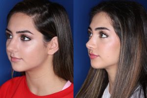 19 year old female 4 months post op from a cosmetic rhinoplasty