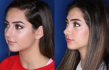 19 year old female 4 months post op from a cosmetic rhinoplasty