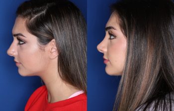19 year old female 4 months post op from a cosmetic rhinoplasty