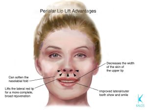Kalos. Perialar Lip Lift Advantages. Can soften the nasolabial fold. Lifts the lateral red lip for a more complete, broad rejuvenation. Decreases the width of the skin of the upper lip. Improved lateral/outer tooth show and smile