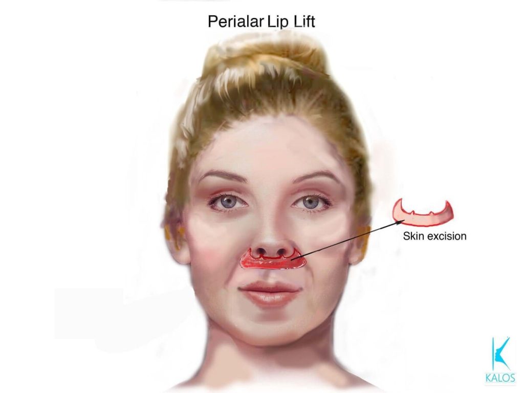 Kalos. Perialar Lip Lift. Skin excision