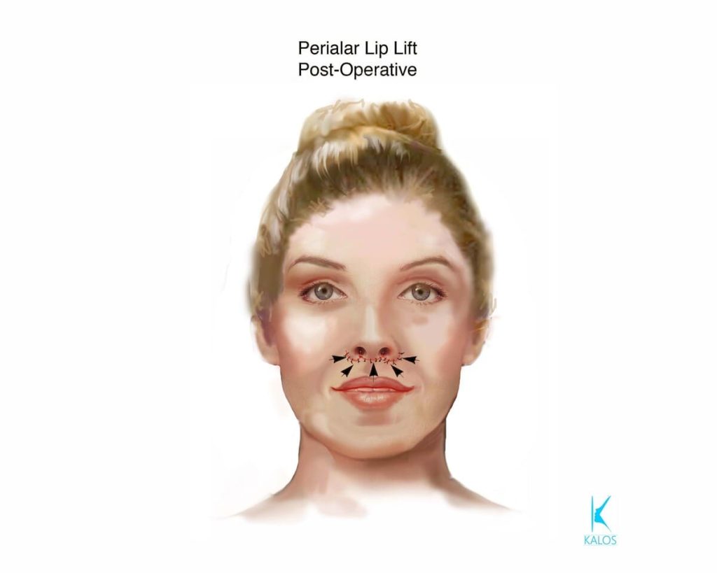 Kalos. Perialar Lip Lift Post-Operative