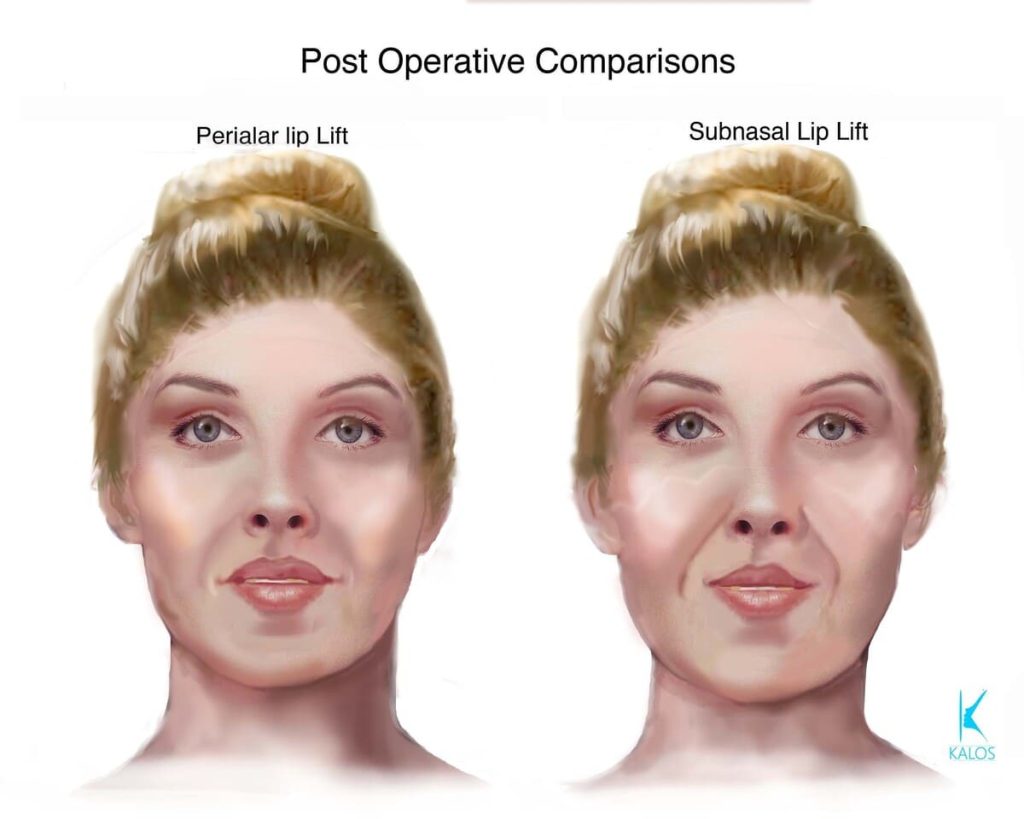 Kalos. Post Operative Comparisions. Perialar lip Lift. Subnasal Lip Lift