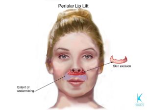 Kalos. Perialar Lip Lift. Skin excision. Extend of undermining.