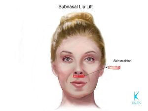 Kalos. Subnasal Lip Lift. Skin excision