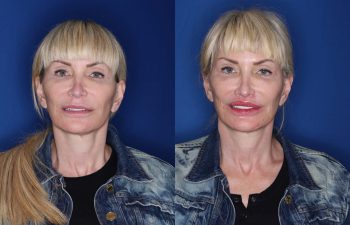 53 year old female 5 months post op from a perialar lip lift