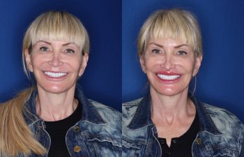 53 year old female 5 months post op from a perialar lip lift