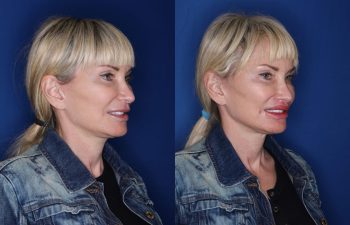 53 year old female 5 months post op from a perialar lip lift