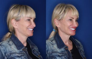 53 year old female 5 months post op from a perialar lip lift