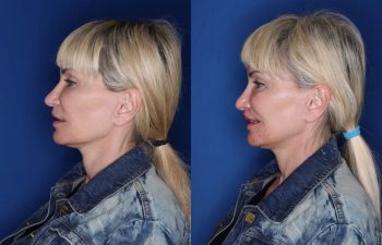 53 year old female 5 months post op from a perialar lip lift