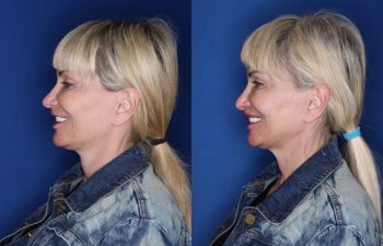 53 year old female 5 months post op from a perialar lip lift