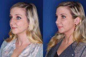 29 year old female 4 months post op from a cosmetic rhinoplasty