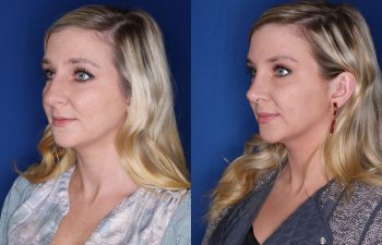 29 year old female 4 months post op from a cosmetic rhinoplasty