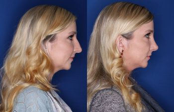 29 year old female 4 months post op from a cosmetic rhinoplasty