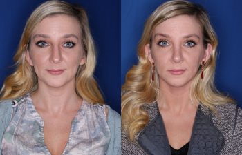 29 year old female 4 months post op from a cosmetic rhinoplasty