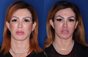 45 year old female 2.5 months post op from a perialar lip lift