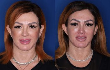 45 year old female 2.5 months post op from a perialar lip lift