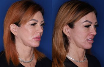 45 year old female 2.5 months post op from a perialar lip lift