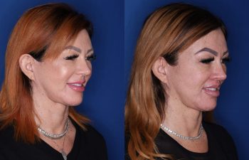 45 year old female 2.5 months post op from a perialar lip lift