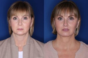 50 year old female 4 months postop from a lower eyelid blepharoplasty, perialar lip lift, buccal fat removal, and extended deep plane facelift