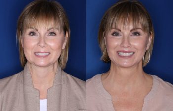50 year old female 4 months postop from a lower eyelid blepharoplasty, perialar lip lift, buccal fat removal, and extended deep plane facelift