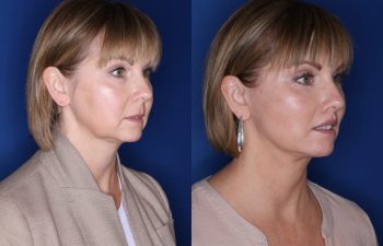 50 year old female 4 months postop from a lower eyelid blepharoplasty, perialar lip lift, buccal fat removal, and extended deep plane facelift