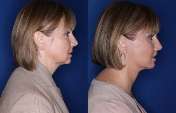 50 year old female 4 months postop from a lower eyelid blepharoplasty, perialar lip lift, buccal fat removal, and extended deep plane facelift