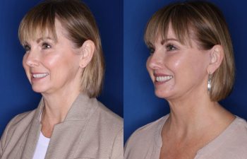 50 year old female 4 months postop from a lower eyelid blepharoplasty, perialar lip lift, buccal fat removal, and extended deep plane facelift