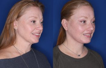 53 year old female 1 month post op from an upper blepharoplasty, extended deep plane facelift, and perialar lip lift.