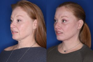 53 year old female 1 month post op from an upper blepharoplasty, extended deep plane facelift, and perialar lip lift.