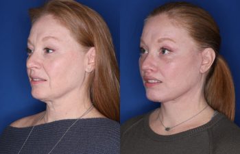 53 year old female 1 month post op from an upper blepharoplasty, extended deep plane facelift, and perialar lip lift.